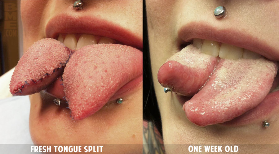 Fresh Pierced Tongue Picture