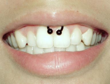 Black Circular Barbell Gum Piercing Picture