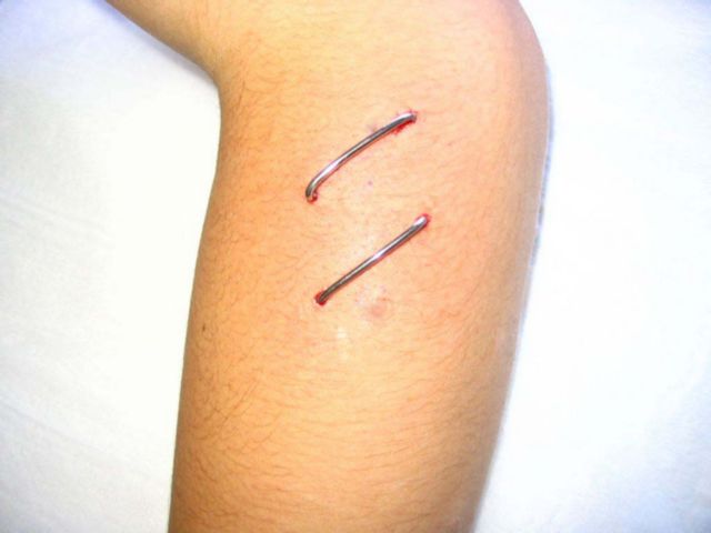 Double Staple Piercing On Left Arm