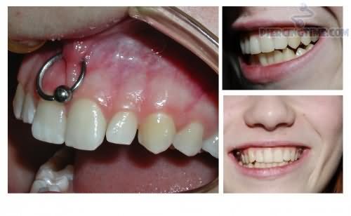 Gum Piercing Ideas For Girls