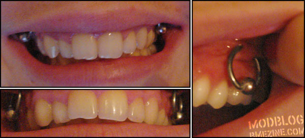 Gum Piercing With Bead Rings