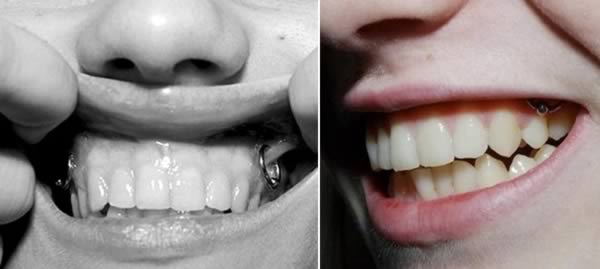 Latest Gum Piercing  For Girls