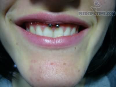 Smiley Gum Piercing With Circular Barbell