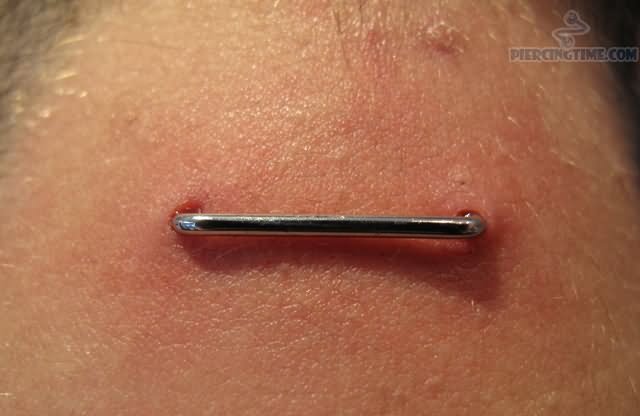 Staple Piercing On Back Neck