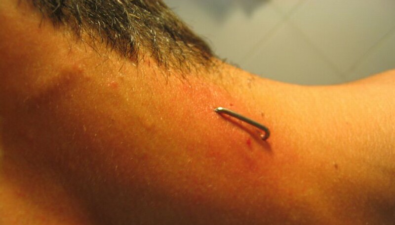 Staple Piercing On Side Neck