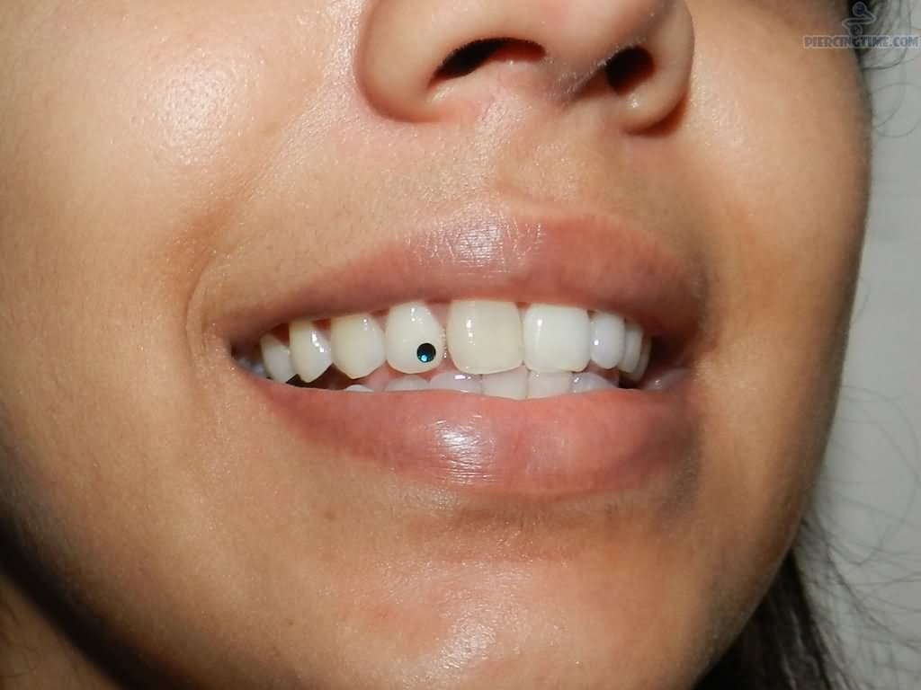 Tooth Piercing With Color Jewel