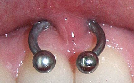 Mouth Piercing With Circular Barbell