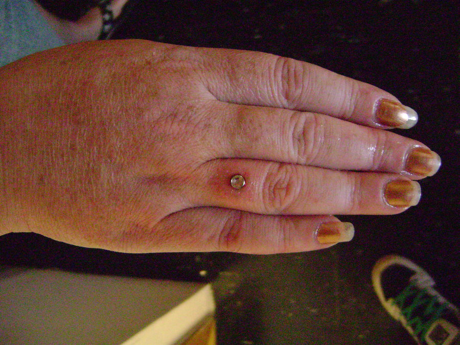 Finger Ring Piercing With Microdermal