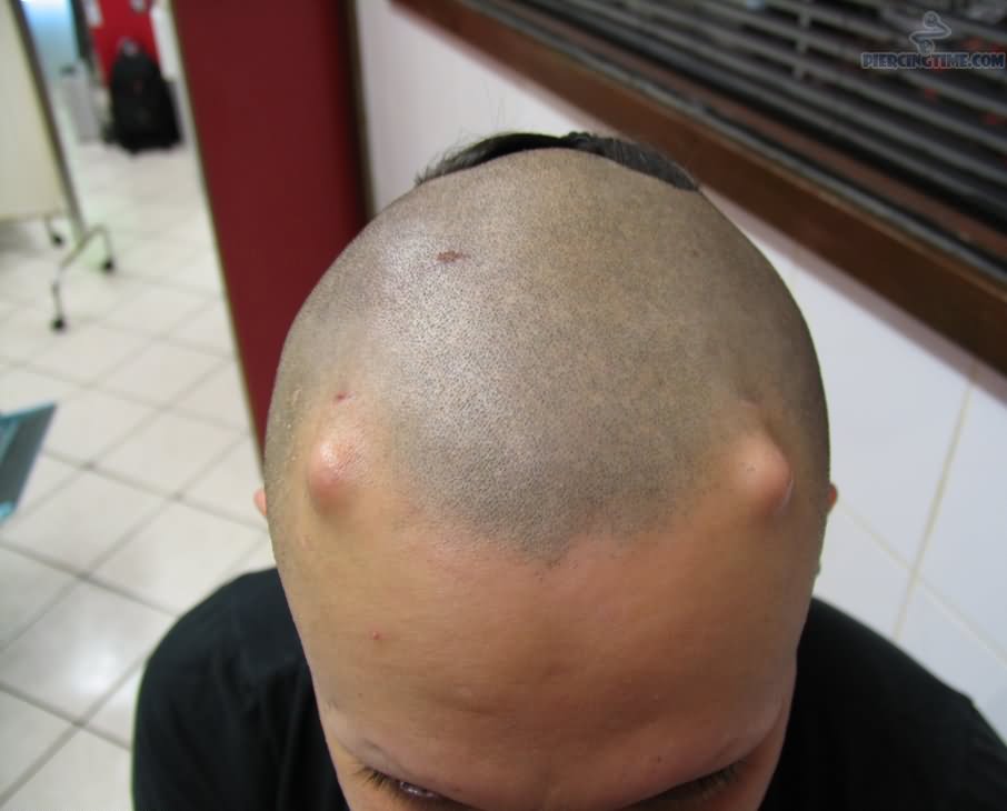 Implants Piercing On Head