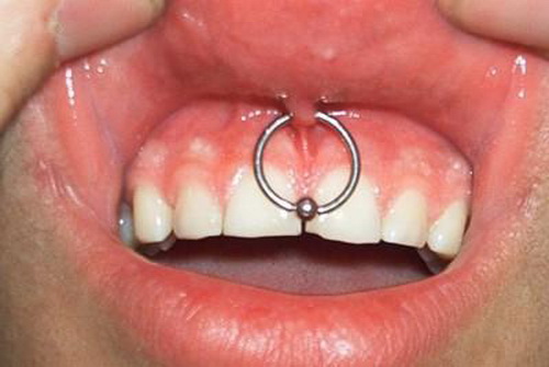 Awesome Lip Frenulum Piercing With Silver Bead Rings