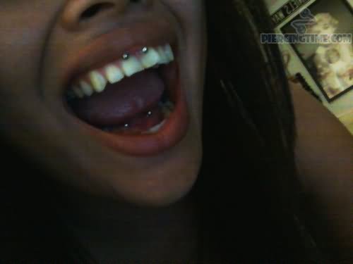 Lip Frenulum Piercing With Circular Barbell