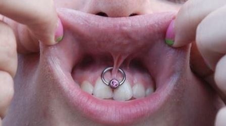 Lip Frenulum Piercing With Pink Bead Ring