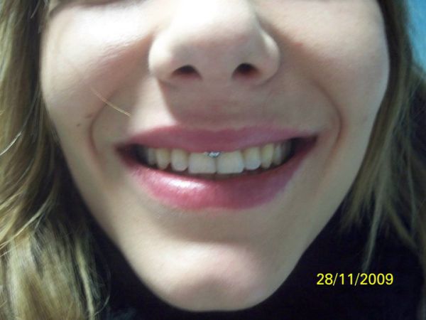 Lip Frenulum Piercing With Silver Bead Ring For Girls