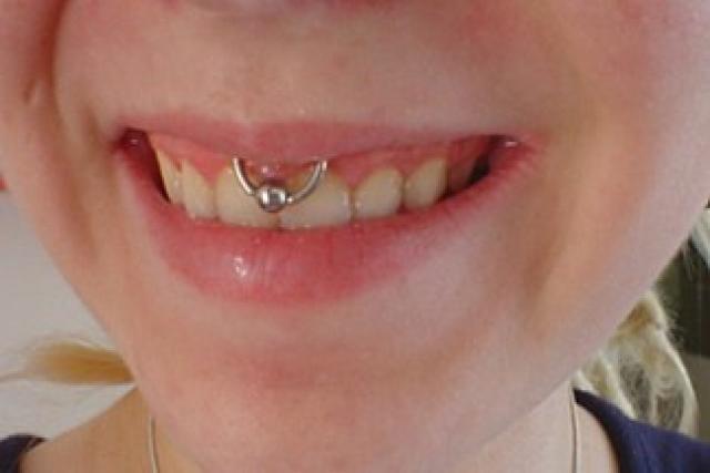 Silver Bead Ring Upper Lip Piercing Picture