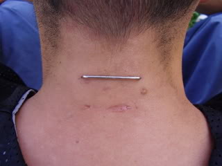 Pocketing Piercing on Back Neck