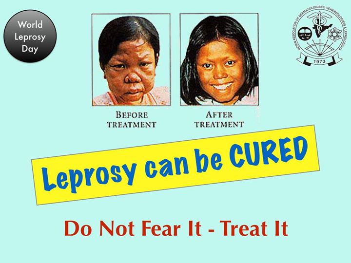 Leprosy Can Be Cured Do Not Fear It Treat It World Leprosy Day